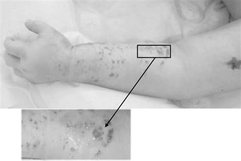 Resolving congenital hemangioma. | Download Scientific Diagram