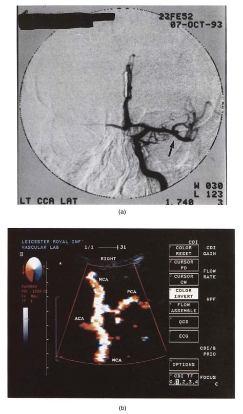 A Intra Arterial Digital Subtraction Angiogram Common Carotid Artery