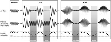 Sleep Apnea And Obesity Hypoventilation Syndrome Flashcards Quizlet
