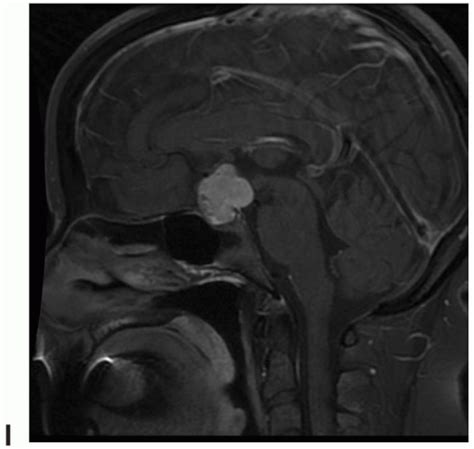 Tumors Of The Sellar Region Radiology Key