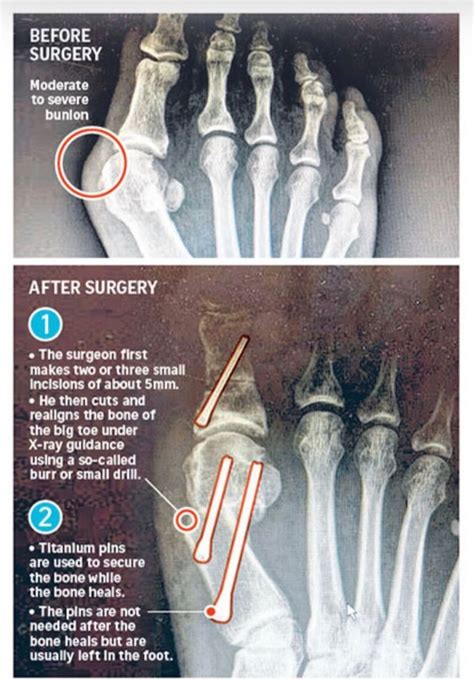 Mis Bunion Minimally Invasive Bunion Surgeon Bunion Surgery Ankle