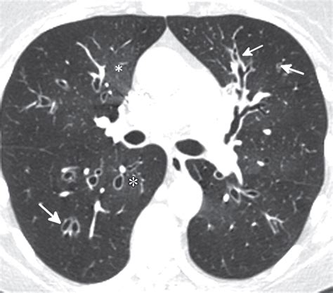 Mosaic Attenuation Etiology Methods Of Differentiation And Pitfalls