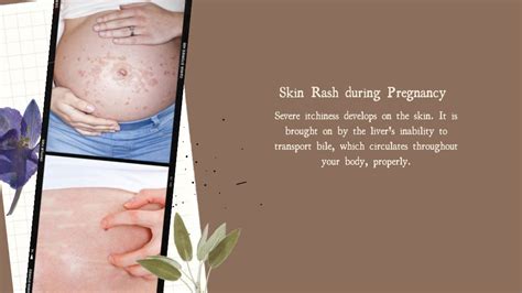 Ppt Skin Problems During Pregnancy Powerpoint Presentation Free