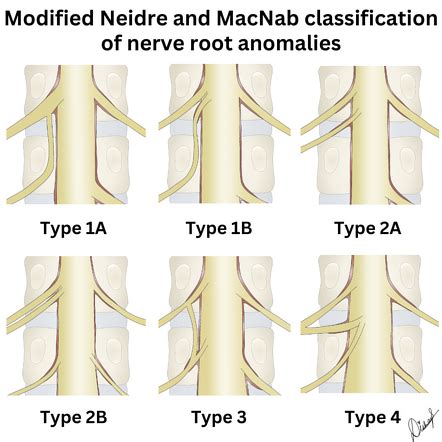 Lumbar Nerve Root Anomaly Classification Radiology Reference Article