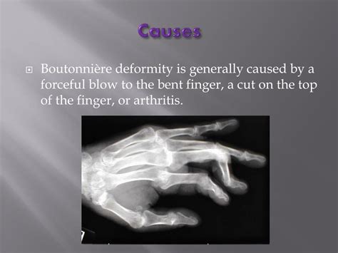 PPT - Boutonniere Deformity PowerPoint Presentation, free download - ID:2016941