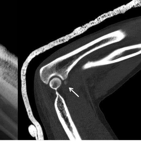 A Sagittal X Ray Elbow After Reduction The CT And In MR T2w Sagittal