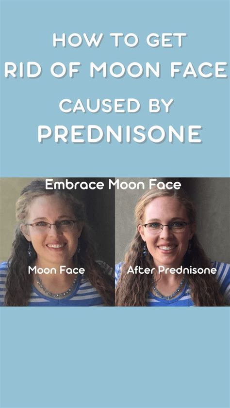 Moon Face Prednisone Moon Face Moon Face Bloated Face