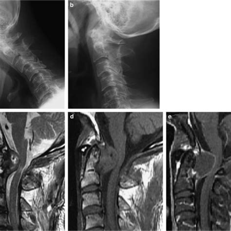 Preoperative Imaging Of The Cervical Spine Dynamic Radiography In A