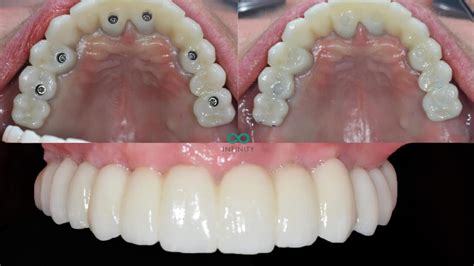 Full Dental Implants