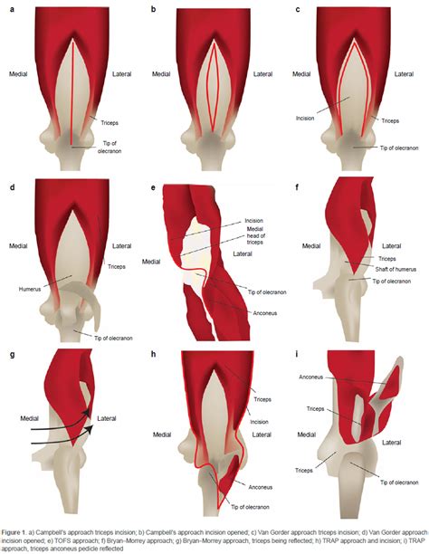 Triceps Off Transfascial Sleeve Approach Functional Outcomes And