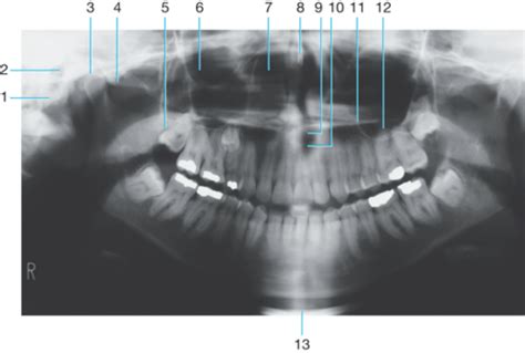 Chapter Recognizing Normal Radiographic Anatomy Panoramic