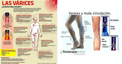 Varices Qué Son Cómo Prevenirlas Y Cómo Tratarlas Varices Consejos Para La Salud Varices