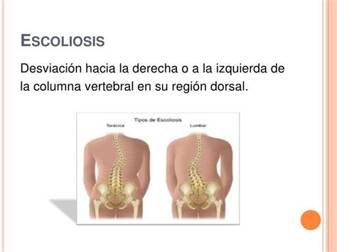 Principales Enfermedades Causadas Por Una Mala Postura Corporal