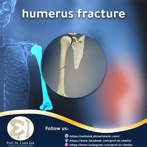 Humerus fracture; From diagnosis to treatment - Dr. What's wrong with you?