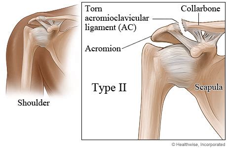 Shoulder separation | UK Healthcare