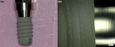 Titanium Corrosion Mechanisms In The Oral Environment A Retrieval Study