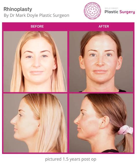 Rhinoplasty Recovery Goldcoastplasticsurgery Au