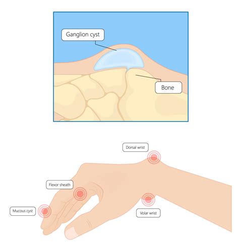 Hand And Wrist Ganglion Cysts Orthosport Victoria