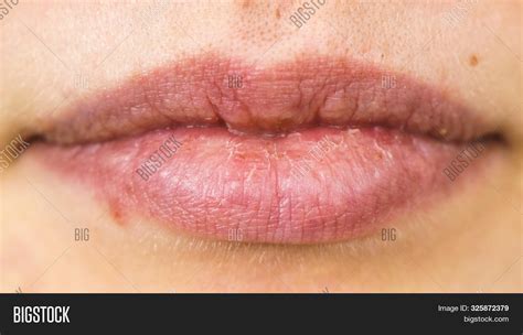 Female Dry Lips Herpes Image And Photo Free Trial Bigstock