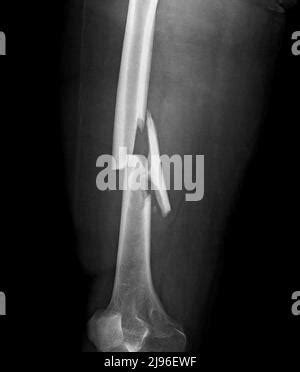 Comminuted Femur Fracture X Ray Stock Photo Alamy