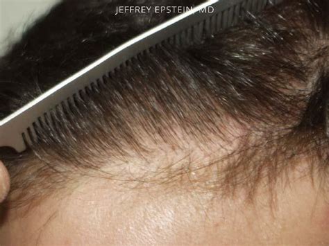 Close Up Hair Transplant Photos Hair Restoration Miami