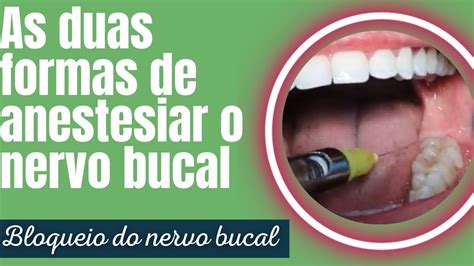 Sabia Que Existem Duas Formas De Anestesiar O Nervo Bucal ANESTESIA