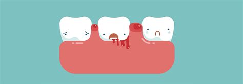 How to stop bleeding gums - Life Care Dental Clinic