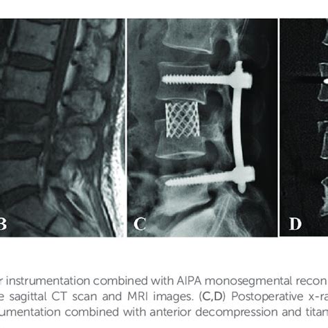 Spinal Hyperextension Hyperflexion Ab A Patient With L2 Fracture