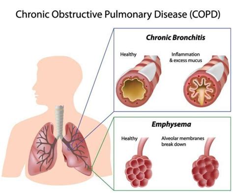 Living With COPD Asthma Foundation NZ