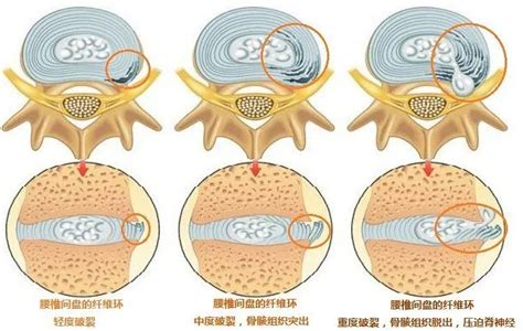 腰椎突出和膨出哪个更严重？腰椎间盘突出和膨出的区别 知乎