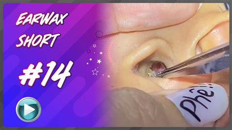 Remove Earwax Asmr Ear Cleaning Esp 2 Youtube