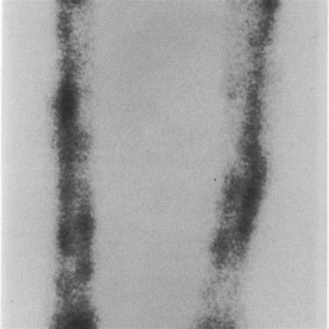 99 Tc (technetium) radionuclide bone scan showing increased uptake in ... 