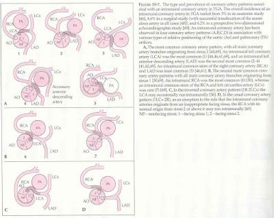 Pedi cardiology: Gen: Coronary Artery Anomalies in d-TGA, TOF, l-TGA...