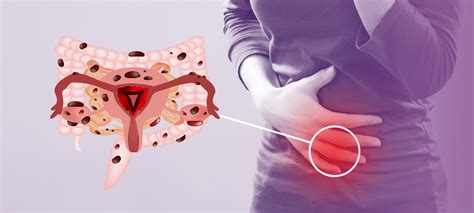 Endometriose Intestinal Conhe A Mais Sobre A Doen A Cl Nica Reproduce