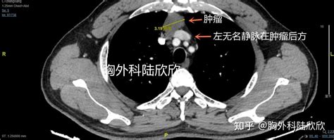 剑突下胸腔镜手术切除前纵隔9厘米胸腺肿瘤 知乎