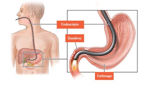 Endoscopia E Colonoscopia Dr Renar