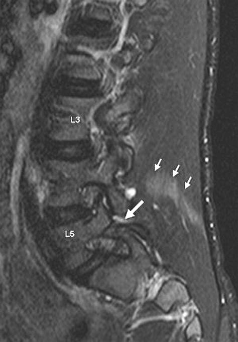 The Imaging And Management Of Nonconsecutive Pars Interarticularis Defects A Case Report And