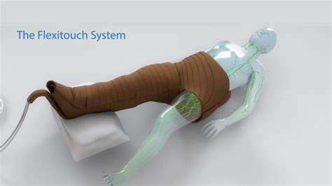 Treating Lymphedema - The Flexitouch System Lymphedema Pump - YouTube