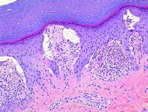 Dermatitis herpetiformis pathology | DermNet