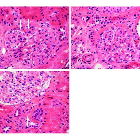 Pictures Showing Findings On The Renal Biopsy A Arteriolar Intimal Download Scientific