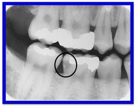 Radiology Chp 33 Interpretation Of Caries Flashcards Quizlet