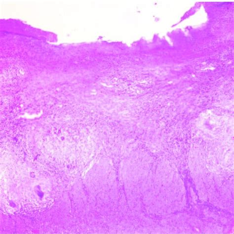 Surgical Material Of Intestinal Tuberculosis With Typical Granulomas Download Scientific