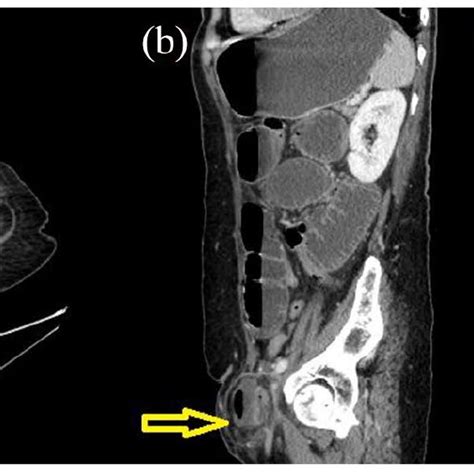 Us Of Left Groin Area Showed Left Groin Abscess Download Scientific Diagram