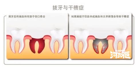 拔牙一定要上午拔？ 知乎