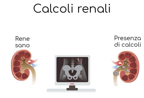 Rimedi Per I Calcoli Renali