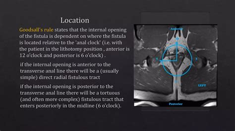 Radiological Imaging In Perianal Fistula Ppt