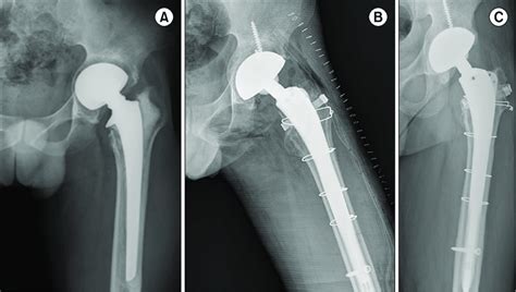 A A Year Old Man Had Acetabular Protrusion After Bipolar