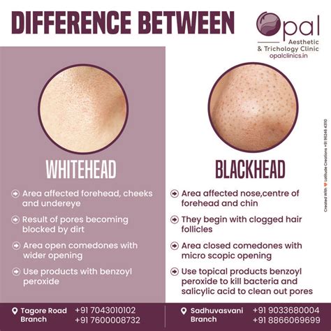 🔍 Spot The Difference Between Blackheads And Whiteheads With Opal