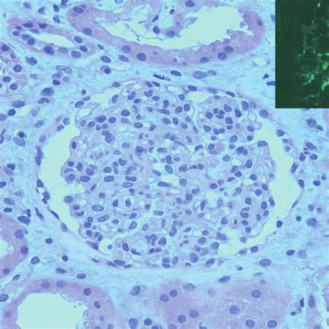 Kidney Biopsy Light Microscopy H E 40 10 Showed Mesangial