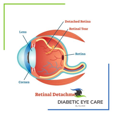 Retinal Detachment Treatment Diabetes Eye Care